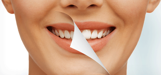 بلیچینگ دندان در مشهد و روش انجام آن